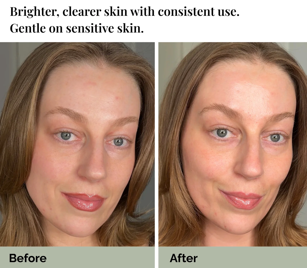 Halina André Azelaic Lotion