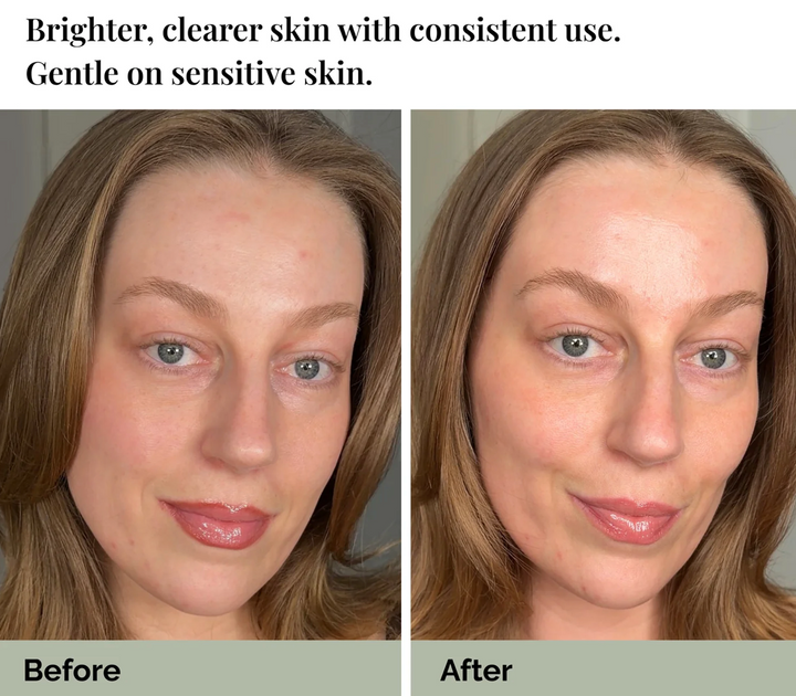 Halina André Azelaic Lotion